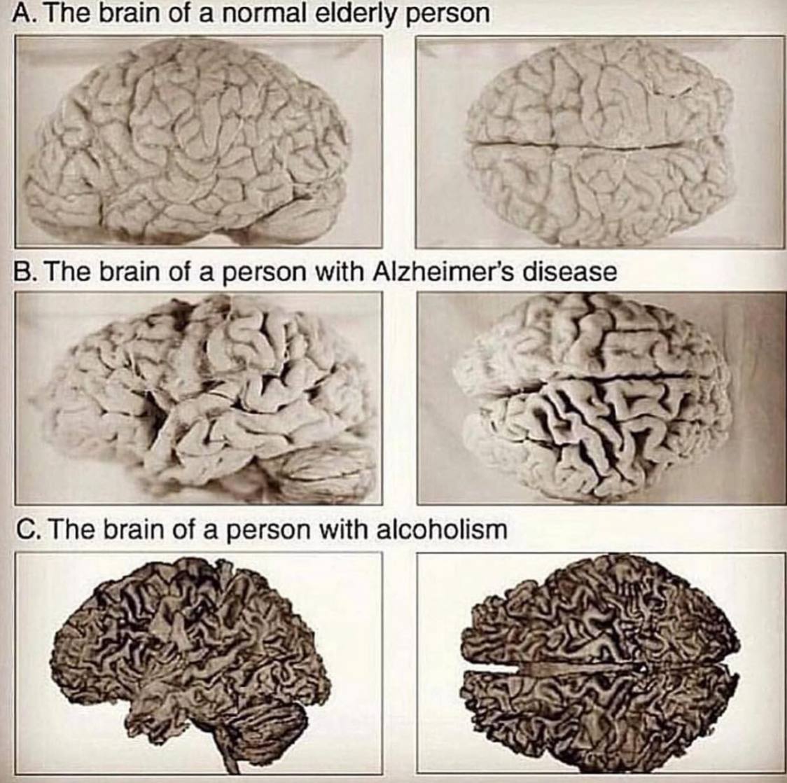 Мозг алкоголика и здорового человека картинки