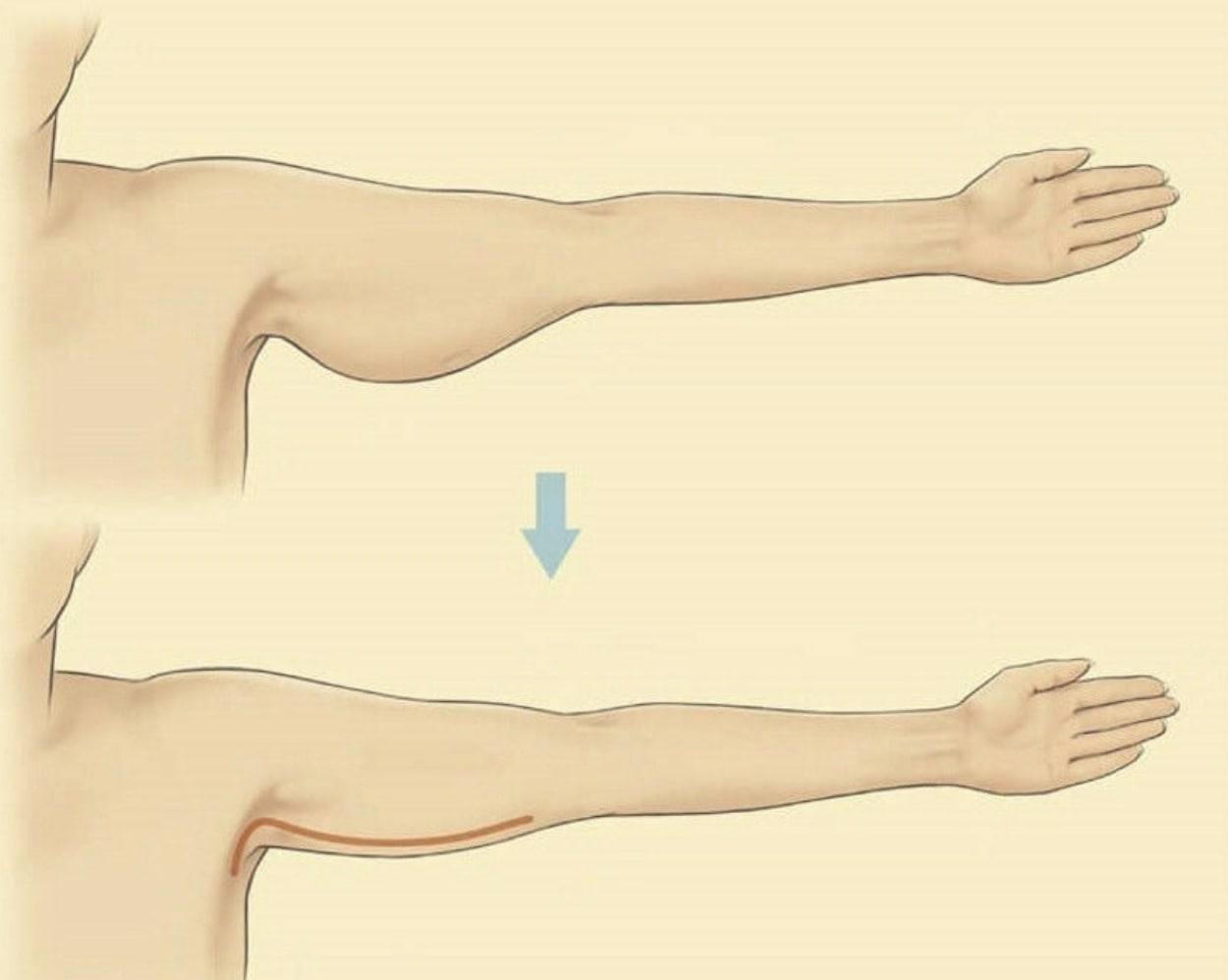 Внутренняя поверхность плеча. Упражнения для обвисшей кожи на руках. Занятие для рук обвисшая кожа. Гимнастика для обвисших рук.